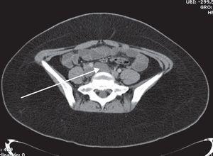 Imagen de TC de abdomen, donde se observa una lesión quística en el retroperitoneo.