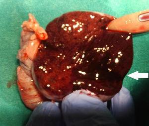 Pieza de orquiectomía derecha abierta por cara anterior en la que se observa, macroscópicamente, el infarto testicular con transformación hemorrágica en el polo inferior (flecha blanca).