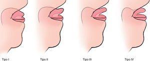 Clasificación anatómica de Coryllos •Tipo I: Frenillo fino y elástico; la lengua está anclada desde la punta hasta el surco alveolar y se observa en forma de corazón. •Tipo II: Frenillo fino y elástico; la lengua está anclada desde 2-4mm de la punta hasta cerca del surco alveolar. •Tipo III: Frenillo grueso, fibroso y no elástico; la lengua está anclada desde la mitad de la lengua hasta el suelo de la boca. •Tipo IV: El frenillo no se ve, se palpa, con un anclaje fibroso o submucoso grueso y brillante desde la base de la lengua hasta el suelo de la boca.