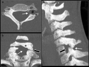 a) Plano axial: ausencia del pedículo izquierdo (flecha blanca) con aparente aumento del agujero de conjunción, hipoplasia de la porción dorsal de la apófisis transversa izquierda (asterisco), ensanchamiento del agujero transverso (almohadilla). La aparente lámina de C6 corresponde a la lámina de C5 hipertrofiada. b) Plano coronal: ausencia del pilar articular de C6 (flecha blanca), hipertrofia de las apófisis articulares izquierdas de C5 y C7 con neoarticulación entre ambas (flecha negra) y engrosamiento de la lámina de C5 (asterisco). c) Plano sagital: ausencia de pedículo izquierdo de C6 (flecha negra) y articulación entre quinta y séptima vértebras cervicales (flecha blanca).