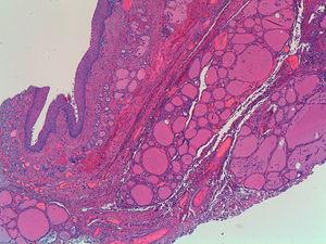 Anatomía patológica: H-E 40×. Quiste revestido de epitelio pavimentoso no queratinizante. Tejido tiroideo periférico.