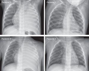 Radiografías inicial y final de 2 pacientes representativos con derrames pleurales masivos que no se drenaron. El tiempo transcurrido entre ambas imágenes fue aproximadamente de 3 meses (como fue habitual en la mayoría de nuestros casos).