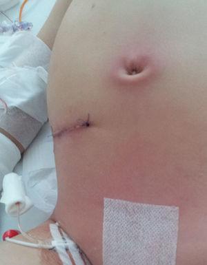 Onfalitis por contigüidad y distensión abdominal, en lactante de 23 meses, en el postoperatorio inmediato de apendicitis perforada.