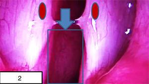 Exploración laringotraqueoscopía: se visualiza tumoración subglótica posterolateral izquierda (flecha). Cuerdas vocales (círculos).