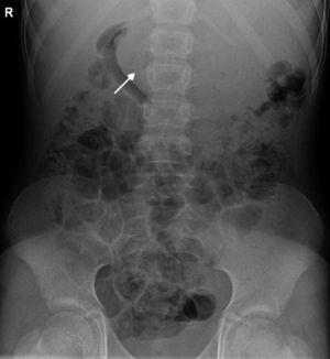 Radiografía abdominal anteroposterior en la que puede objetivarse una masa que ocupa casi la totalidad de la luz gástrica.