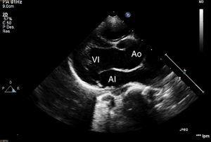 Dilatación de raíz aórtica (25mm, Z-score +4) en ecocardiografía realizada en paciente con síndrome de Loeys-Dietz. AI: aurícula izquierda; Ao: raíz aórtica;VI: ventrículo izquierdo.