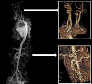 Dilatación y tortuosidad de vasos arteriales con predominio en troncos supraaórticos, tronco celíaco y arteria mesentérica superior en paciente con síndrome de Loeys-Dietz.