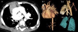A) TC torácica helicoidal con contraste. Se observa agenesia de la arteria pulmonar derecha e hipoplasia pulmonar derecha. B) TC torácica helicoidal con reconstrucciones 3D. B.1) Detalle de la agenesia de la arteria pulmonar derecha. B.2) Ramas colaterales desde aorta descendente que nutren parénquima pulmonar derecho. B.3) Hipoplasia pulmonar derecha.