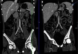 Corte coronal: en la imagen de la derecha (A) se muestra la lesión señalada con la flecha. En la imagen de la izquierda (B) ha desaparecido.
