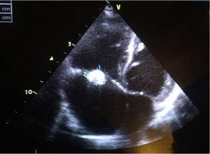 Ecocardiografía al diagnóstico: CIV perimembranosa, vegetaciones en válvula tricúspide, insuficiencia tricuspídea moderada y FEV 72%. Coincidiendo con el diagnóstico de SHF se comprueba rotura de las cuerdas del velo anterior de la válvula tricúspide.