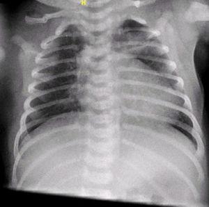 Radiografía de tórax al alta. Disminución del neumomediastino y el enfisema subcutáneo. Desaparición del neumotórax.