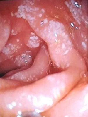 Endoscopia digestiva alta: imagen «en copos de nieve» a nivel duodenal.