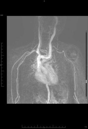 Angio-RMN. Reconstrucción 3D MIP que incluye los trayectos arteriales y venosos de cuello, tórax y miembros superiores. Se aprecia llamativa elongación con formación de bucles de aorta torácica, troncos supraaórticos y ambas arterias axilares y braquiales.
