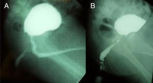 A) Cistouretrografía miccional: uretra normal y trayecto fistuloso entre uretra posterior y periné. B) Fistulografía: fístula uretral con dilatación en sus dos tercios finales.