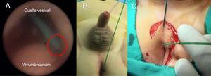 A) Cistoscopia: cateterización de la uretra duplicada. B) Sonda tipo Foley en uretra ortotópica y catéter de Fogarty a través de uretra heterotópica. C) Incisión en lambda perineal.