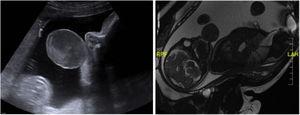 Ecografía y resonancia magnética nuclear prenatales, mostrando una tumoración oral de gran tamaño.
