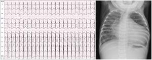 Cardiomegalia con índice cardiotorácico de 0,7 y un patrón hiliofugal en el pulmón derecho. ECG: signos de dilatación del ventrículo izquierdo (R en V6, S en V1) e isquemia miocárdica anterolateral izquierda (descenso de ST y T negativa en i, aVL, V6).