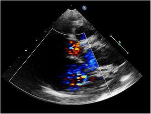 Ecocardiograma que muestra en el eje corto un flujo retrógrado (azul) en la coronaria con probable trayecto coronario emergiendo de la pulmonar.