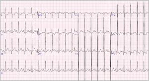 Ecocardiograma a los 6 meses: signos de isquemia subendocárdica con la presencia de onda Q profunda en iii.