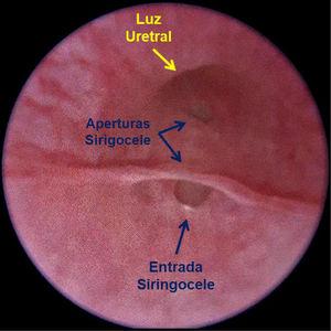 Imagen endoscópica de la uretra bulbar donde se aprecia el hallazgo de un siringocele con apertura a la luz uretral. La forma de apertura del siringocele justifica la dificultad para el sondaje vesical.