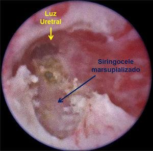 La imagen de la uretra bulbar muestra el resultado de la marsupialización endoscópica del siringocele con electrocoagulación.