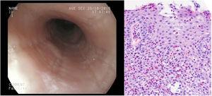 Imagen macroscópica y microscópica de la esofagitis eosinofílica. En la histología se objetivan 30-40 eosinófilos/campo de gran aumento.