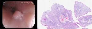 Imagen macroscópica y microscópica (hematoxilina-eosina, 10x) del papiloma escamoso localizado en esófago distal.