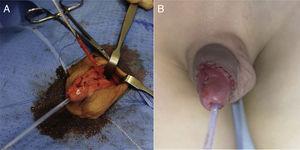 A. Intervención quirúrgica: disección y exéresis de duplicación uretral. B. Resultado al finalizar la intervención.