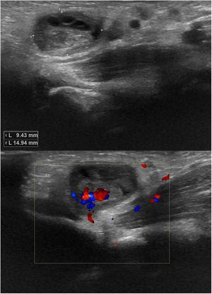 A. Ecografía inguinal. Se identifica una imagen hipoecoica de 9×14mm con áreas hipoecoicas milimétricas dentro del saco herniario. B. Estudio Doppler de la lesión que excluye la presencia de afectación vascular.
