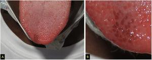 A. Múltiples papilas fungiformes marrones localizadas en la punta de la lengua. B. Aspecto en detalle.