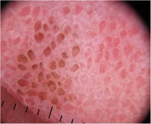 Dermatoscopia (DermLite DL200; modo luz polarizada 10×). Se observan múltiples proyecciones de bordes pigmentados, aspecto semejante a «pétalos de rosa».