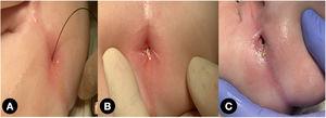 Neoano tras la primera dilatación con balón de 6 mm (A) y suturas cardinales en la unión mucocutánea (B). Aspecto tras 5 meses de dilataciones (C).