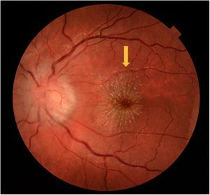 Edema de papila y exudado en área macular (estrella macular) del ojo izquierdo a la semana del diagnóstico (flecha).