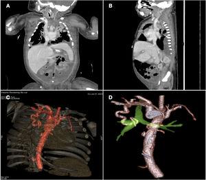 Imágenes de tomografía computarizada (TC). A y B. Trombosis de sistema yugulosubclavio izquierdo. C y D. Arteria bronquial derecha aberrante con origen en la subclavia derecha.