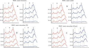 Diagnóstico topográfico empleando pontenciales evocados auditivos de tronco cerebral (PEATC). En estos cuatro casos se representa una hipoacusia de oído izquierdo con umbral entre 20 y 40dB debida a lesión transmisiva (A), coclear (B), retrococlear por alteración en el tronco cerebral (C) y retrococlear por alteración en el VIII par (D). En rojo se colorean las ondas del oído derecho y en azul, las del izquierdo. En cada caso, el gráfico incluye las obtenidas con estímulos de 80, 60, 40 y 20dB. Obsérvese la desaparición de la onda V a 20dB en el oído afectado. Para representar el desplazamiento de las ondas, las líneas verticales continuas marcan la latencia en cada supuesto, y las discontinuas, la latencia que sería normal en cada caso.