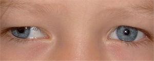 Reflejo de Hirschberg en paciente con exotropía. Esta sencilla prueba se basa en la observación del reflejo sobre la córnea y se mide por la distancia que separa el reflejo corneal del centro de la pupila. Si el reflejo es simétrico y está en el centro de la córnea, existe ortotropía.