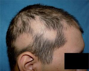Alopecia areata.