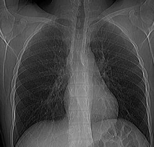 Radiografía de tórax: campos pulmonares bien ventilados, silueta cardiovascular normal. Hilios prominentes. No imágenes de condensaciones o infiltrados.