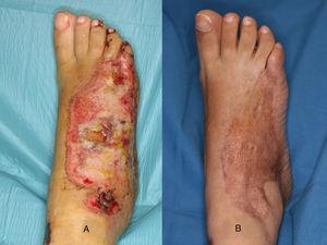 A. Quemadura de 3.er grado en dorso de pie. B. Resultado al año tras cobertura con injerto de piel parcial.