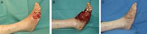 A. Exposición tendinosa en el dorso del pie. B. Disección de colgajo supramaleolar. C. Resultado a los 6 meses.