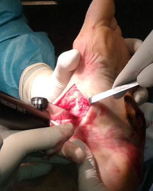 Realización de la osteotomía con sierra oscilante.