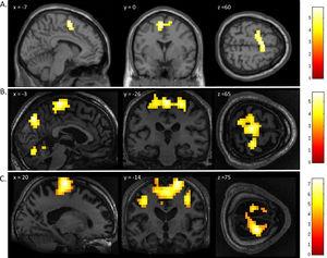 FMRI activation observed during the motor imagery task for a group of healthy participants (A) and two completely locked-in GBS patients (B and C). A. In healthy participants, a whole-brain group analysis revealed significant activation in the supplementary motor area, using a threshold of p < .05, FDR-corrected for multiple comparisons. Group analysis is shown on a canonical single-subject T1 MRI image. B and C. In both patients, extensive significant activation was observed in the supplementary and primary motor cortex. Patients’ results are displayed at a peak voxelwise threshold p < .001, uncorrected followed by whole-brain FDR-corrected for significance using cluster extent, p < .05 and displayed on their individual normalized T1 image.