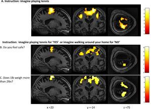 Whole-brain results from Patient 2 for the motor imagery task (A) and two communication scans (B-C). In the communication scans (B-C), the patient's brain activity closely resembles the activity found in the motor imagery task (A) indicating a “yes” response to both questions. Results displayed at a peak voxelwise threshold p < .001, uncorrected, followed by whole-brain FDR-corrected for significance using cluster extent, p < .05 and displayed on the patient's normalized T1 image.