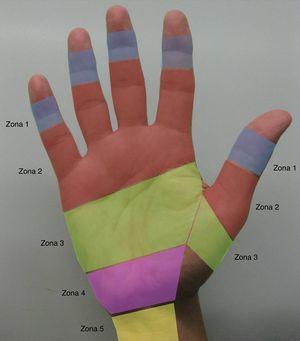 Zonas de lesión de los tendones flexores de los dedos trifalángicos y del pulgar según la Federación Internacional de Sociedades de Cirugía de la Mano.