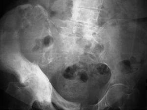 Radiografía simple de pelvis que muestra lesión lítica de gran tamaño en el seno de un hueso pagético en pala ilíaca derecha con destrucción cortical y fracturas.