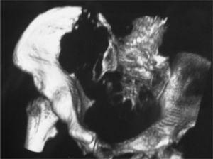 Tomografía computarizada (con reconstrucción tridimensional) de pelvis y caderas que muestra destrucción ósea en pala ilíaca derecha.