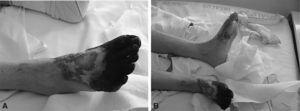 A: gangrena de los dedos y del antepié derechos. B: lesión ulcerativa e isquemia en el pie izquierdo.