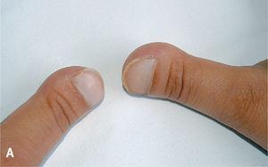 A: imagen del primer dedo de ambas manos de la paciente en la actualidad. B: radiografía de las manos: hipoplasia o acroosteólisis del extremo distal de las falanges distales.