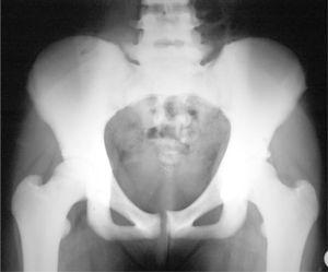 Radiografía de la pelvis y la columna lumbar: aumento de la densidad ósea generalizada con aumento del hueso cortical y trabecular. Osteosclerosis homogénea.