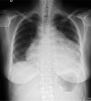 Radiografía en proyección posteroanterior de tórax: se objetiva cardiomegalia global, a expensas de las 4 cavidades. Ligero derrame pleural bilateral.